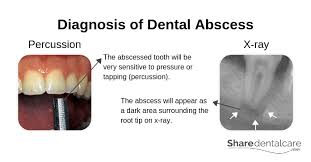 Percussion tests may be considered mistakenly to directly correlate to a pulp's sensibility. Dental Abscess Symptoms Causes Treatment Pictures
