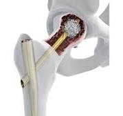 Advanced Nailing System | Products | DePuy Synthes