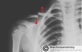 When looking at a radiograph, remember that it determine if it is from a lateral decubitus position. The Clavicle Functions Landmarks Fractures Teachmeanatomy