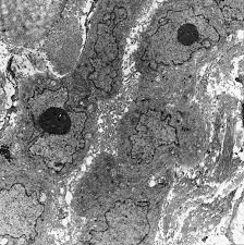 The results of a light and electron microscopic study and enzyme histochemistry of reactive mesothelial cells and diffuse and localized (solitary) pleural. Http Eknygos Lsmuni Lt Springer 266 Part 20six 6 20item Pdf