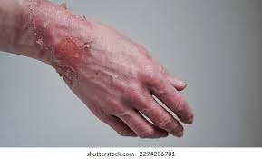 Image result for Skin Trauma