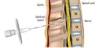 Image result for Intrathecal Pump
