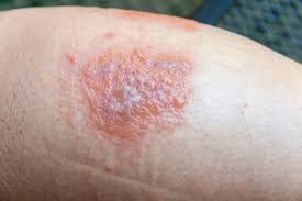 Image result for allergy rash on the legs