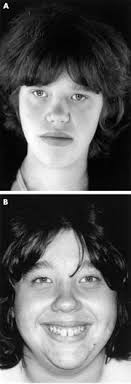 Coffin-Lowry syndrome: clinical and molecular features