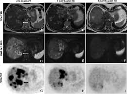 The most common areas of breast cancer metastasis are the bones, brain, lungs, and liver. Images In A 53 Year Old Woman With Metastatic Breast Cancer In The Download Scientific Diagram