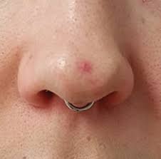 Then you apply it directly on the spots before going to sleep. Cherry Angioma Removal Kent Red Spots Treatment Tunbridge Wells
