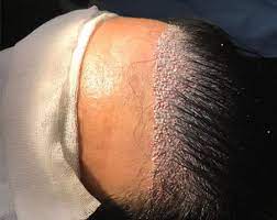 عکس های کاشت موی زنان + کاشت مو در زنان به چه صورت است