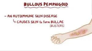 Image result for Pemphigoid