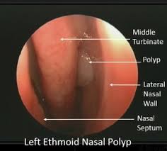 Garrett bennett, new york city sinus surgeon. Nasal Polyp Surgery New York Ny Sinus Surgeon