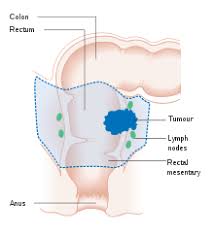 How is rectal cancer diagnosed? Colorectal Cancer Wikipedia