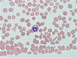 Image result for Anemia angolensis
