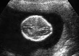 Soft Markers Of Chromosomal Aberrations Radiology Key