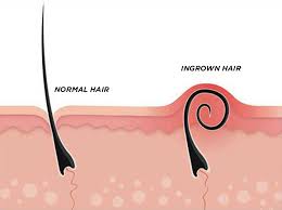 The infection happens at the hair follicles hence it is also called as folliculitis. Ingrown Hair Removal Kit That Works Body4real