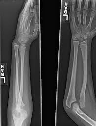 Image result for Radial Head Dislocation