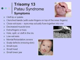Fetal ultrasound during pregnancy can also give information about the possibility of trisomy 18 or 13, but ultrasound is not 100 percent accurate because some babies with trisomy 18 and 13 may look the same on ultrasound as those without the syndrome. Pin By Nonas Arc On Trisomy 13 Aka Patau Syndrome Patau Syndrome Nursing Journal Trisomy 13