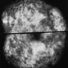 Generally, whiter mammogram images indicate denser breasts. Mammogram Images Normal And Abnormal