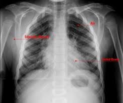 What Is An X Ray For Kids Radiology And Medical Imaging