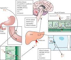 References In Wilson S Disease And Other Neurological Copper Disorders The Lancet Neurology