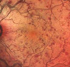 Trombosis venosa profunda trombosis causa nhseal la, comida para comer para coágulos de sangre. Trombosis Ocular Que Es Y Cual Es Su Tratamiento