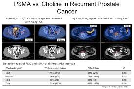 If you have been diagnosed with adenocarcinoma cancer, you have a cancer that developed in one of the glands that lines the inside of your organs. The Role Of Molecular Imaging In Managing High Risk And Recurrent Pca