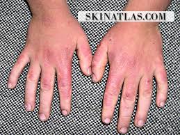 Image result for Photodermatitis