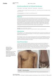 Poland syndrome is noted for the underdevelopment or absence of the chest (pectoralis) muscles on one side of the body as well as webbing of the fingers (cutaneous syndactyly). Pdf Brachysyndactyly In Poland Syndrome