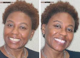 Teeth whitening typically costs between $99 to $367 per session: Zoom Whitening Cosmetic Teeth Whitening In Brooklyn