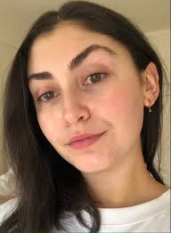 What to Know About Laser Treatments for Red Acne Marks