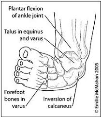 3 Parts To Deformity Talipes Talus Is Inverted And Internally Rotated Equinus Ankle Is Plantar Flexed Varus Hee Pediatrics Foot Deformities Medical Problems