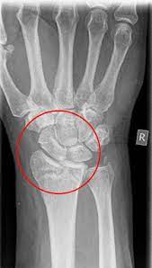 Distale Radiusfraktur Op Zentrum Orthopadie Chirurgie
