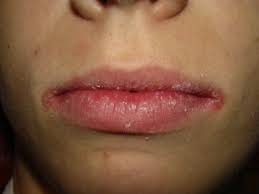 Image result for Angular Stomatitis