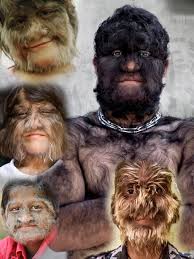 Werewolf syndrome or hypertrichosis is a traumatic situation for people who suffer from this condition. Hypertrichosis Also Known As Werewolf Syndrome Is An Extremely Rare Condition Characterized By Excessive Hair Growth Otherwise The Person Is Healthy 9gag