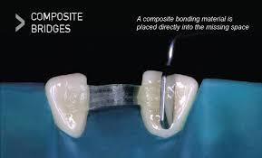 Maybe you would like to learn more about one of these? Types Of Dental Bridges What Type Is Best For Me