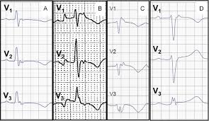 Image result for Epsilon Wave