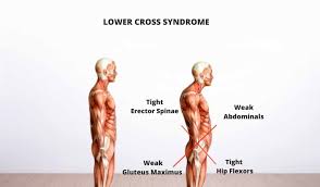 How To Fix Your Posture Lower Cross Syndrome
