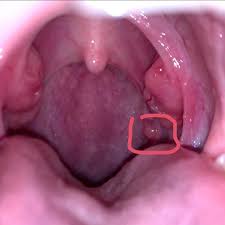 Many symptoms of throat cancer do not develop in the early stages of the disease. Does That Little Circle Look Like Throat Cancer Also Have Had A Sore Throat For 3 Months Now Tested Negative For Strep Will Be Going To Doc Again Soon Ent