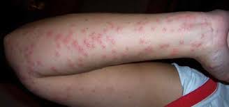 Image result for bedbug bites look like