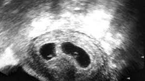 Bei den meisten frauen ist in den ersten drei monaten nichts von der schwangerschaft zu sehen: Zwillinge In Der 6 Woche Ssw5 Babywelten Ch