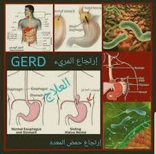 السبب الاول هو ضعف حمض المعدة و تكو ن احماض اخرى من الطعام الغير مهضوم جيدا بسبب ذلك لذلك الافضل تناول ملعقة خل تفاح غير مفلتر في كوب blog detox blog posts
