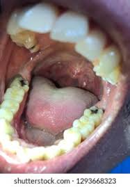 Image result for Tonsillolith