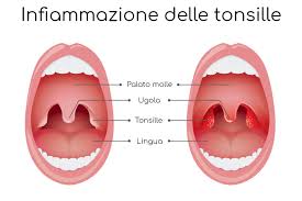 Mal di gola solo da un lato: cosa significa? Cause e rimedi
