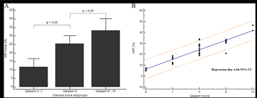 What is prostate cancer grading, and what does your gleason score mean? Differences Between The Asphericity For Prostate Cancer Lesions With A Download Scientific Diagram