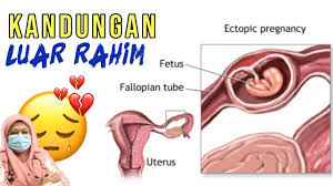 Sebelum memahami tajuk ini, anda perlu kenal pada sistem peranakan wanita yang terdiri daripada uterus (rahim), 2 ovary (kilang telur), 2 fallopian tubes (tiub fallopian), dan vagina. Kandungan Luar Rahim Ectopic Pregnancy Youtube