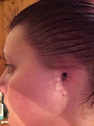 In the united states, it's estimated that doctors diagnose over 100,000 new skin cancer cases each year. Sunbed Addict Has Blackened Ear Amputated After Wart Turned Out To Be Aggressive Skin Cancer