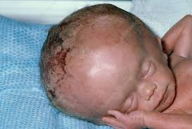 Image result for Hydrocephalus