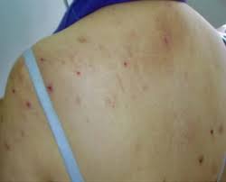 Image result for Neurotic Excoriation