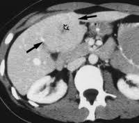 Pin By Phan Ninh On Abdomen Radiology Subcutaneous Emphysema Pancreas