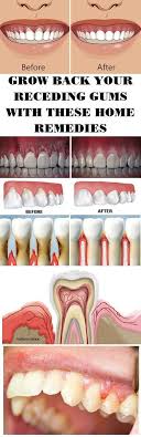 Pin By Gare Ajap On Slim And Fit 3 Gum Health Receding Gums Oral Health Care