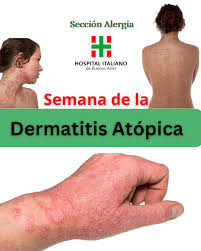 Image result for dermatitis contacta allergica