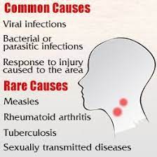 Swollen Lymph Nodes Swollen Lymph Nodes Swollen Lymph Nodes In Neck Lymph Nodes In Neck